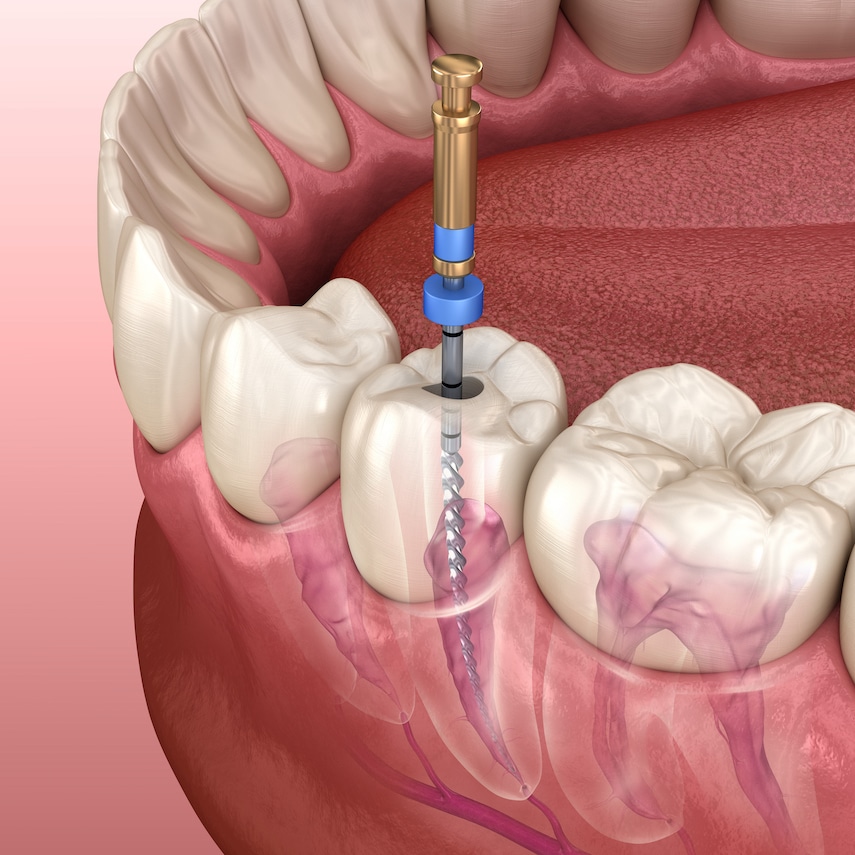 root canal treatment - emergency dentistry