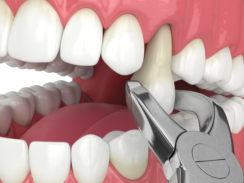 Tooth Extraction - Emergency Dentistry
