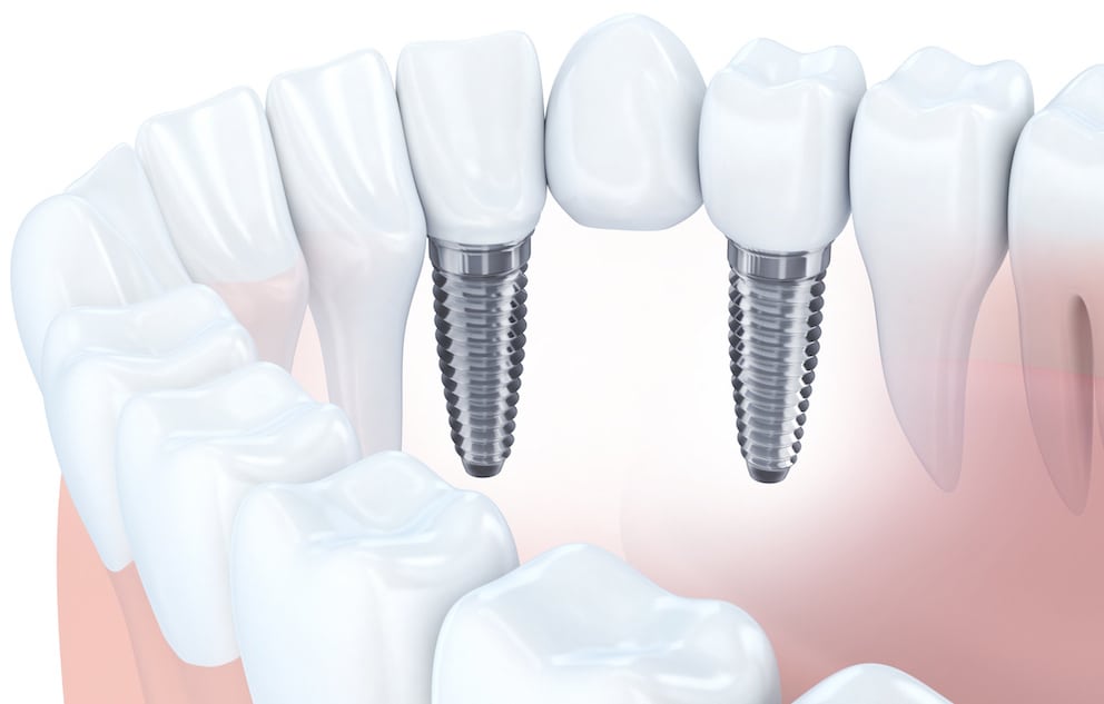 What is a dental implants?