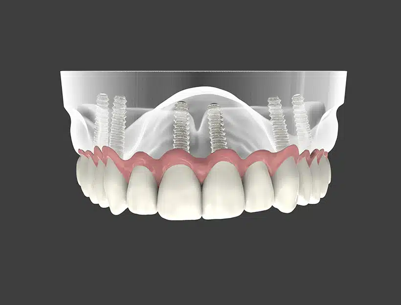 Cost Of Full Mouth Dental Implants Details
