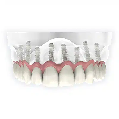 Full Mouth Dental Implant vs. Low Cost Denture Implants​.