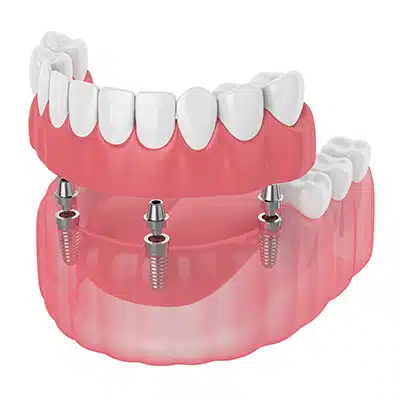 Permanent Dentures/Denture Implants