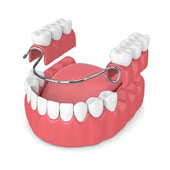 Removable Partial Dentures