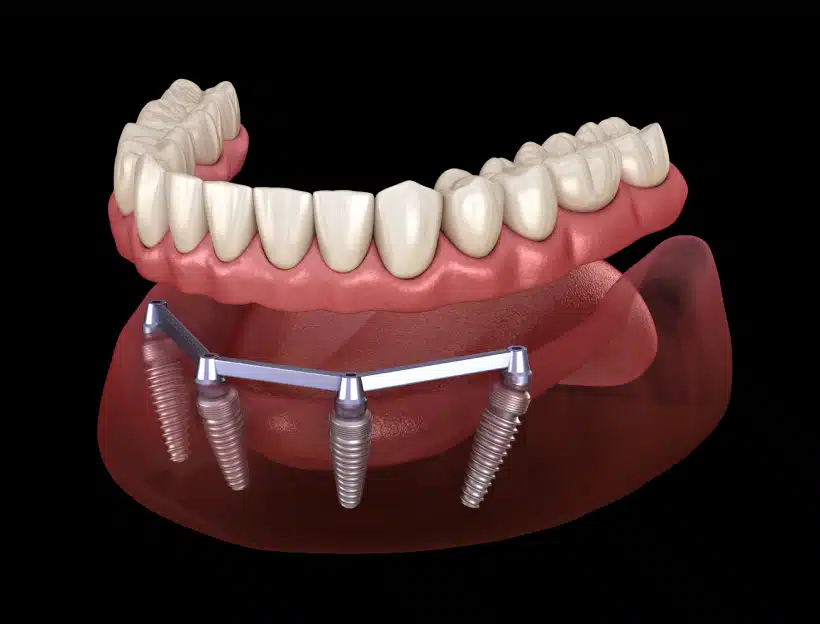 Factors Influencing the Lifespan of Dental Implants​