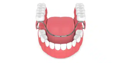 Lower Partial Denture