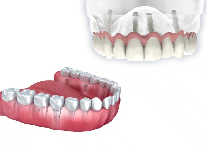 All-on-4 vs traditional dental implants