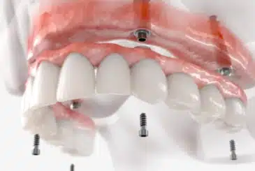 ALL-ON-4®
$19,500
All-on-4 Dental Implant Treatment Starting At $19,500

Read More