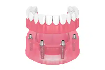 DENTURE STABILIZATION
$2995

Replace missing teeth for just $2975 And get $300 off any additional implants needed.


Read More
