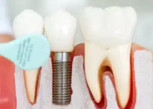 How long does a dental implant procedure take