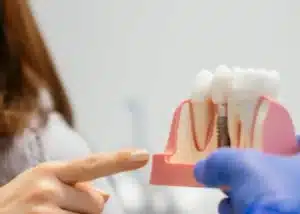 dental Implants Cost