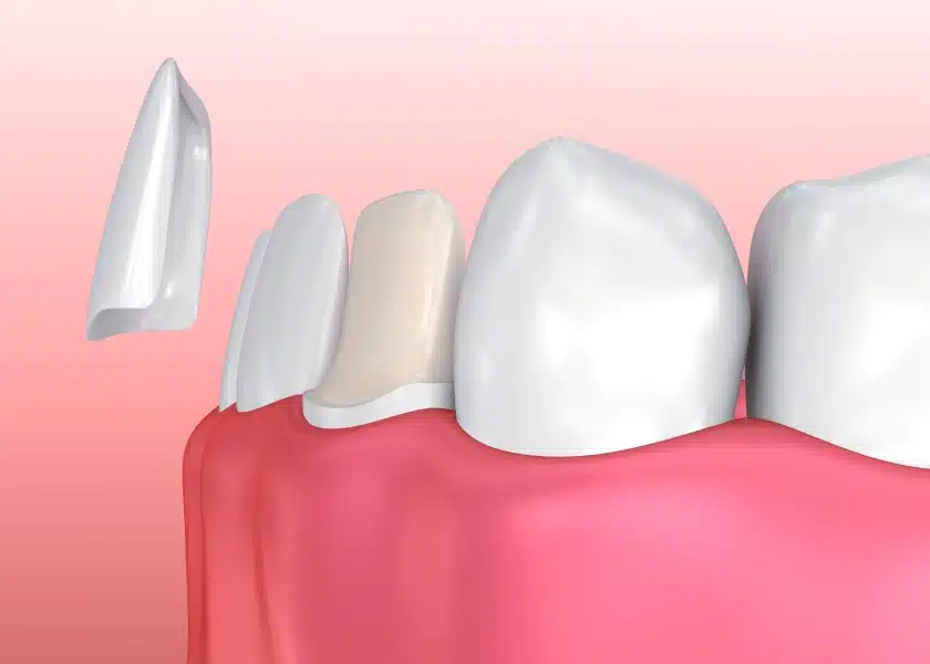 How much do veneers cost