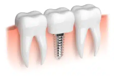 IMPLANT 
$2975
Replace missing teeth for just $2975 And get $300 off any additional implants needed.

Read More