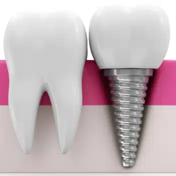 Tooth Implant
