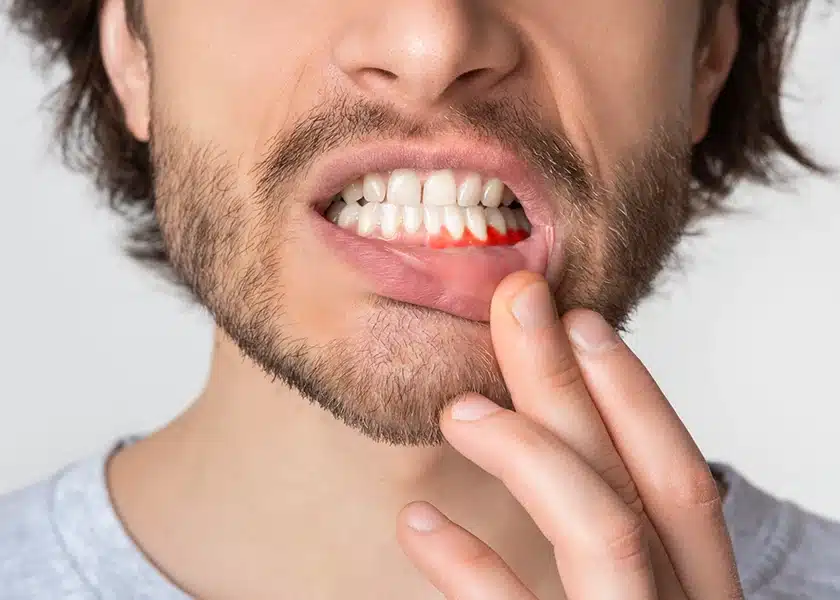 Gum Disease Vs Root Canal