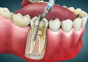 How Long Does a root canal take